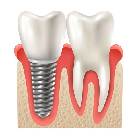 Astra Tech Dental Implants: Revolutionizing Tooth Replacement