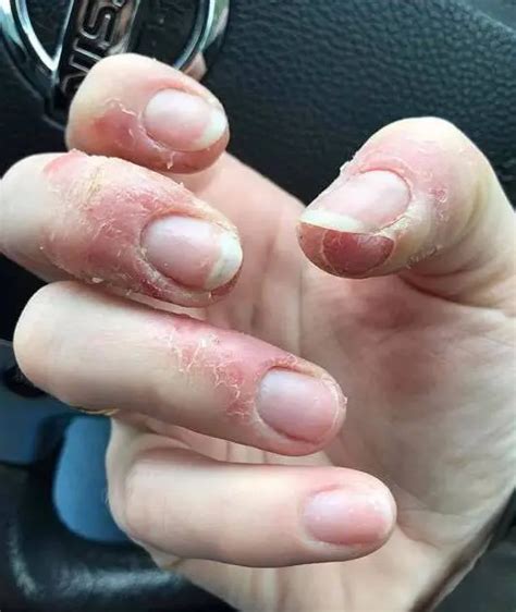 Contact Dermatitis In Nail Techs: Causes And Solutions