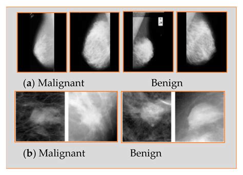 Mammo Tech: The Future Of Breast Cancer Detection