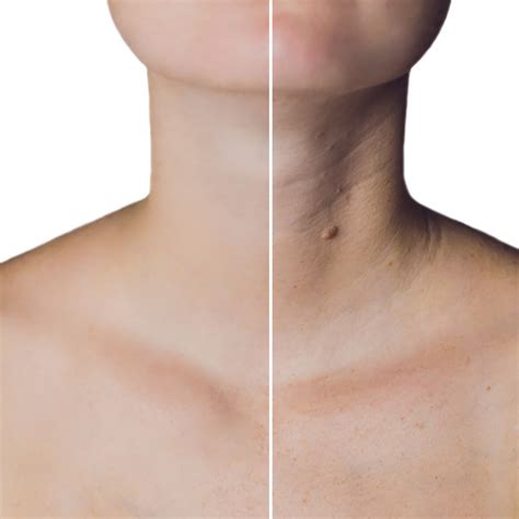 Tech Neck Botox: A Solution For Smartphone Wrinkles